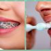 Consejos para el cuidado e higiene de dientes con brackets