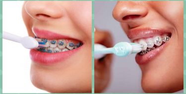 Consejos para el cuidado e higiene de dientes con brackets